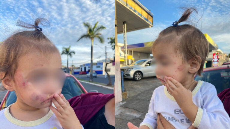 Bebê volta de creche de Sumaré com mordidas no rosto; Educação ...